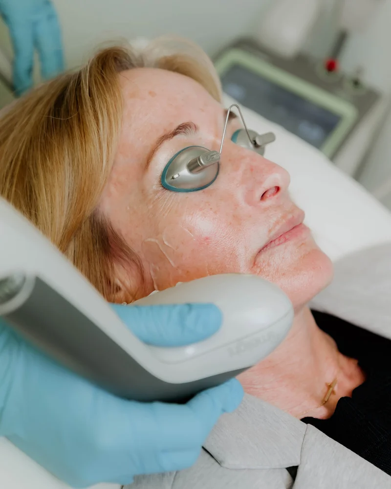 Laser skin treatment at Northshore Skincare
