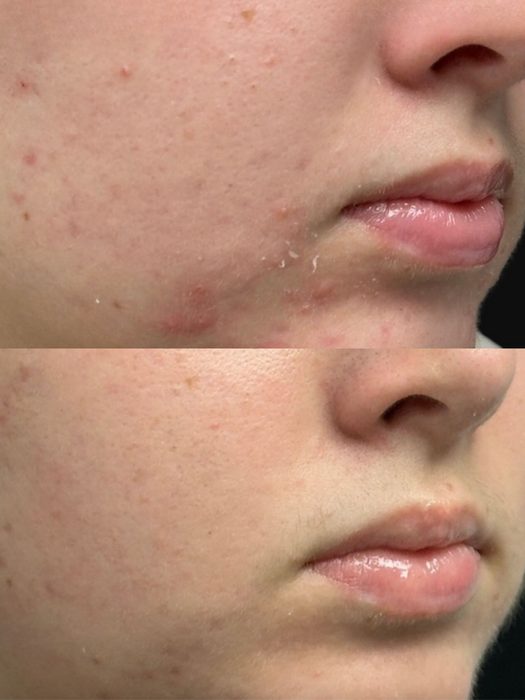 Before and after acne treatment