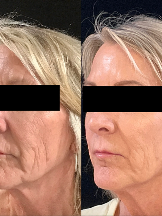 Before and after Pearl laser treatment